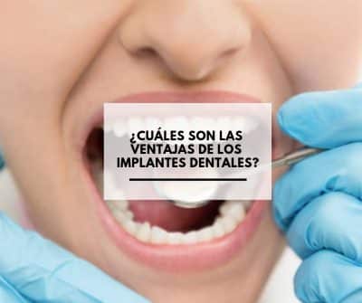 ¿Cuales son las Ventajas de los implantes dentales?. CEM Valderas Dentistas en Alcorcón