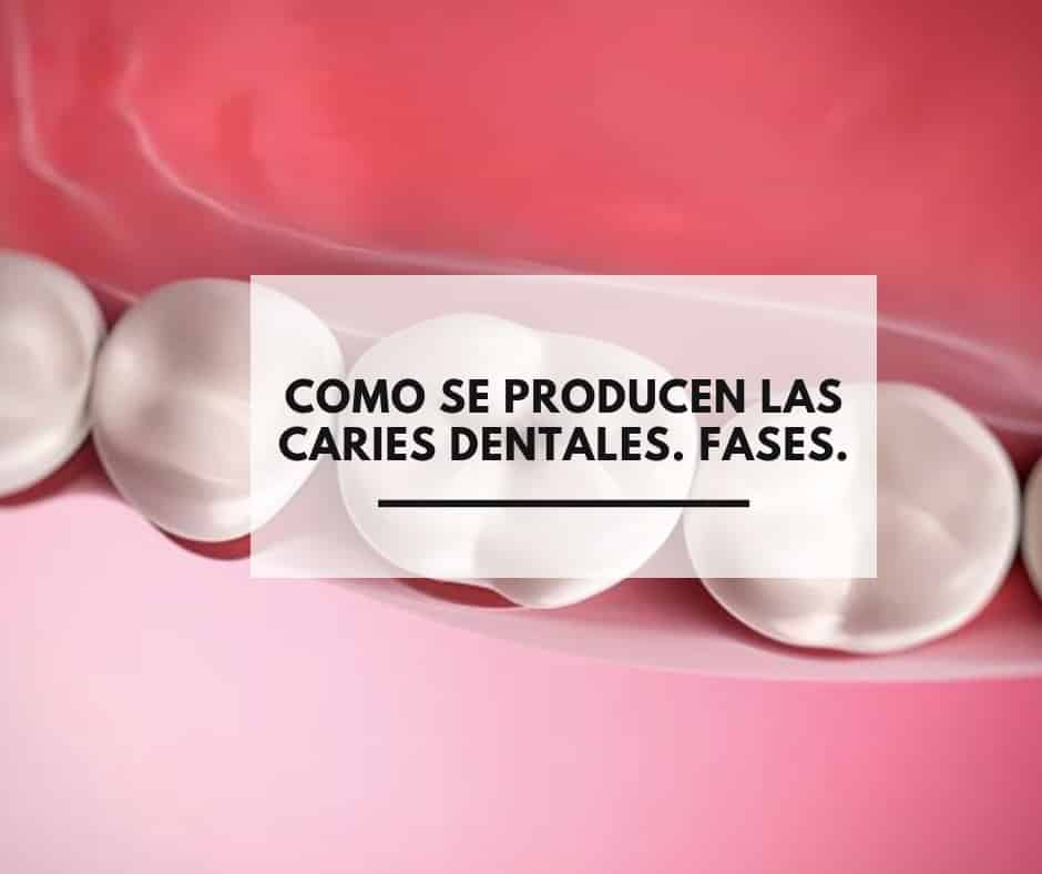Dentistas Alcorcón. ¿Como se prodcucen las caries dentales?. Fases