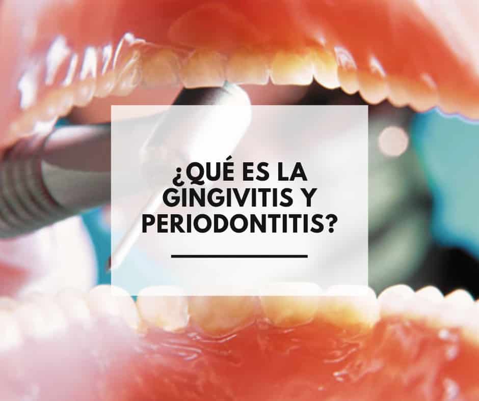 ¿Que es la Gingivitis y Periodontitis?. Dentistas Alcorcón CEM Valderas