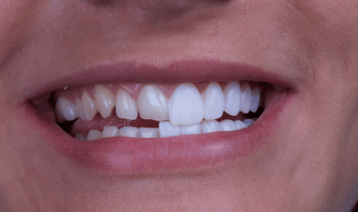 Pasos para colocar carillas de porcelana. CEM Valderas clínica dental en Alcorcón