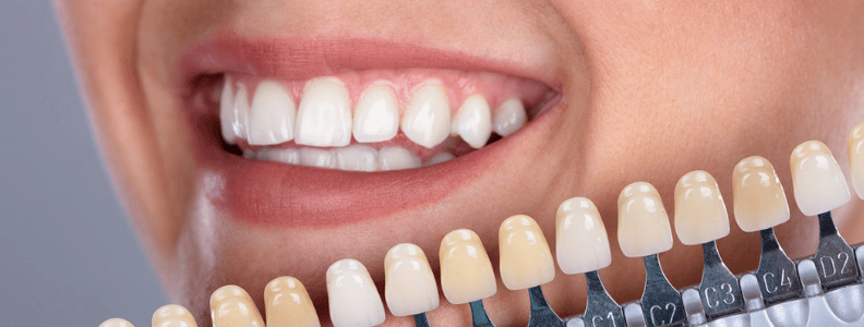 Las carillas dentales son cubiertas delgadas que se adhieren a los dientes﻿. Clínica Dental CEM Calderas expertos en tratamientos de estética dental