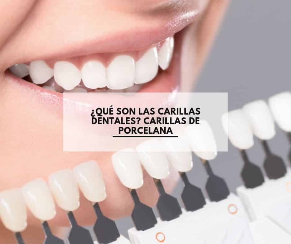 ¿Qué son las carillas dentales? Carillas de porcelana. CEM Calderas Clínica Dental Alcorcón