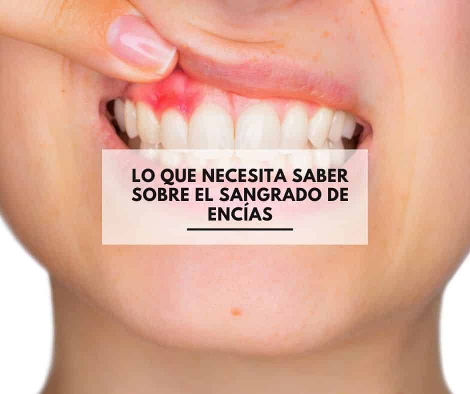 Lo que necesita saber sobre el sangrado de encías