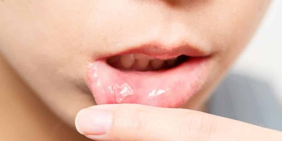 estrés y salud dental