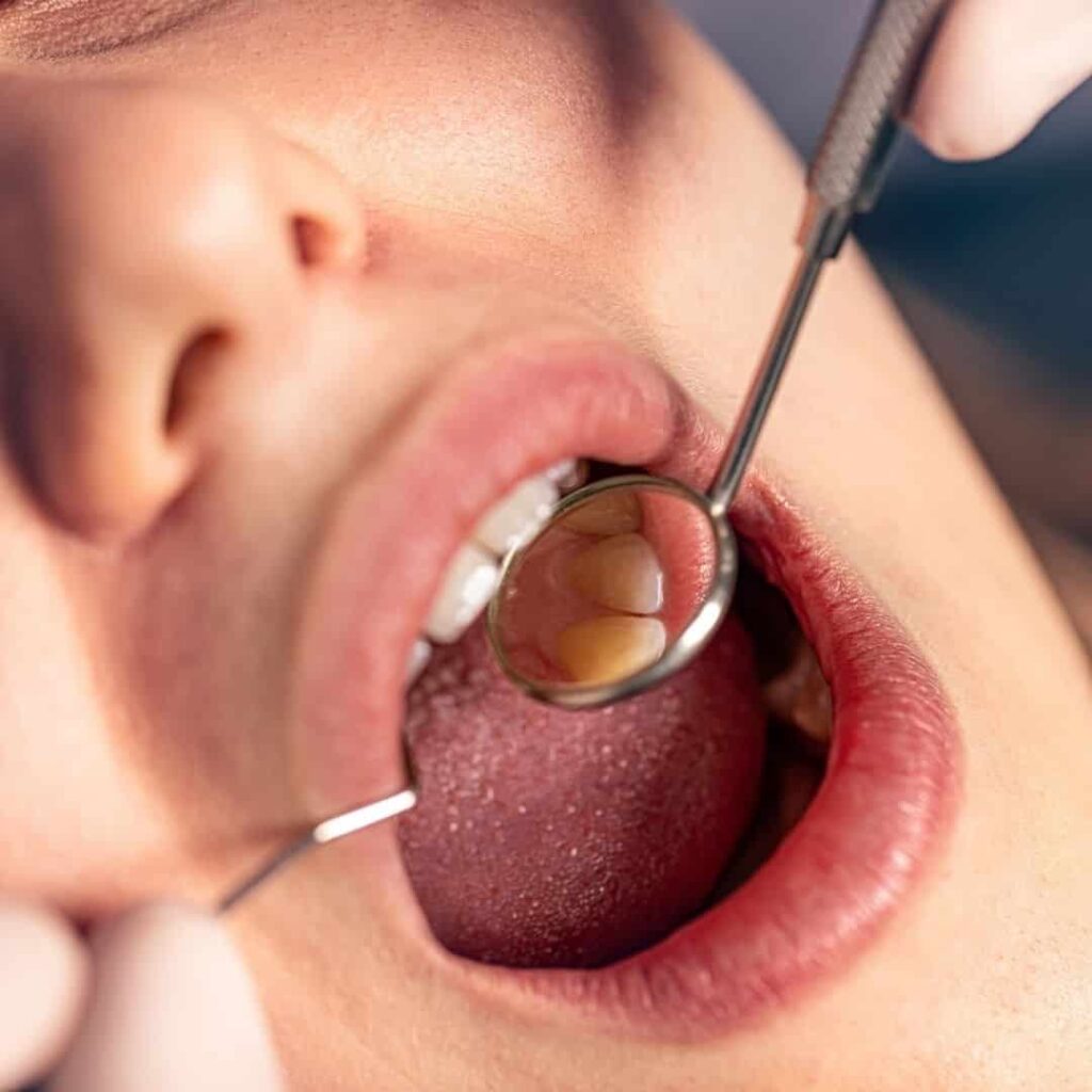 retracción de las encías