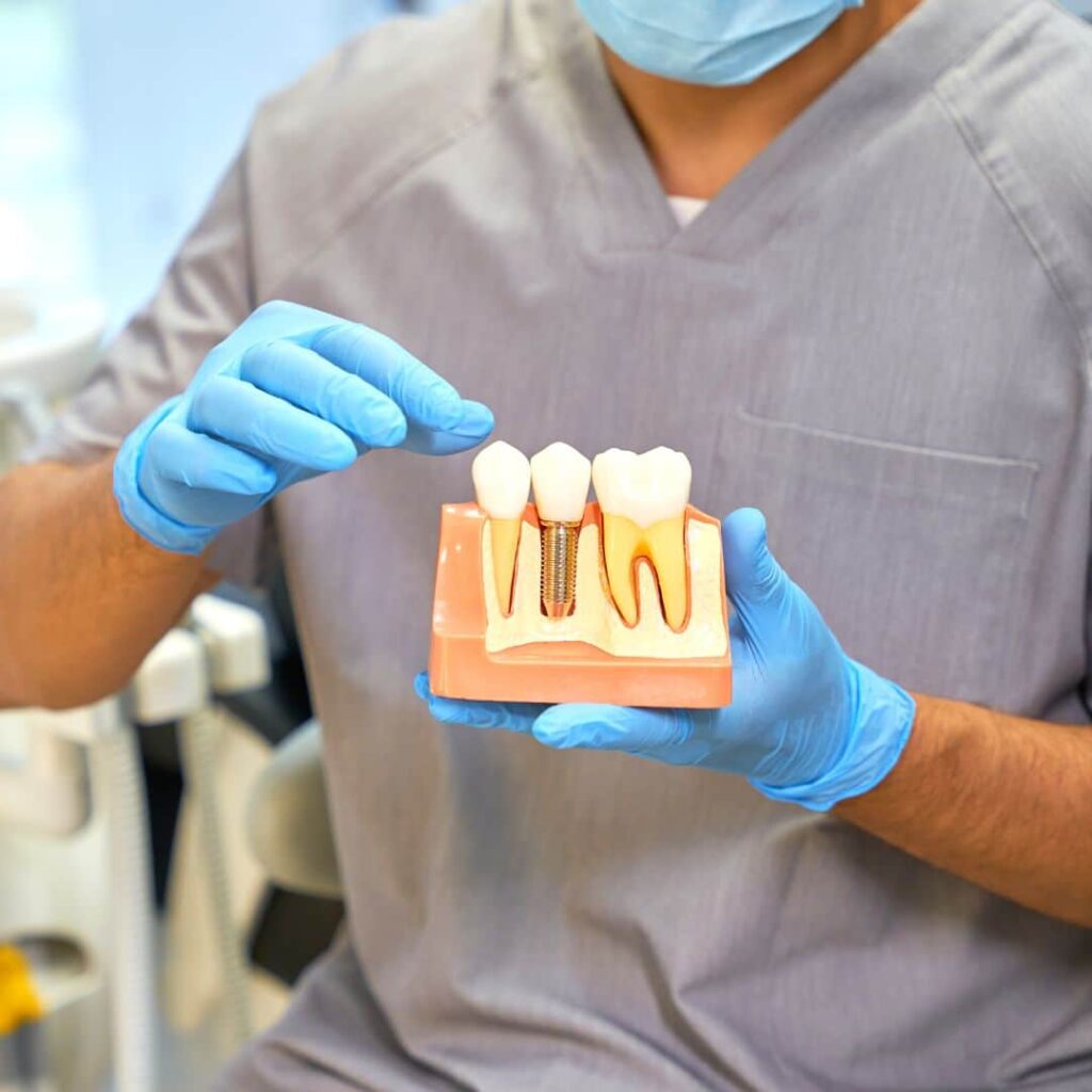 implantes dentales