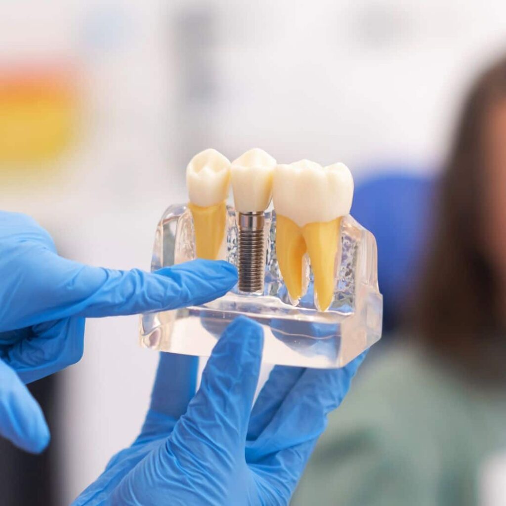 Cuidado de los implantes dentales