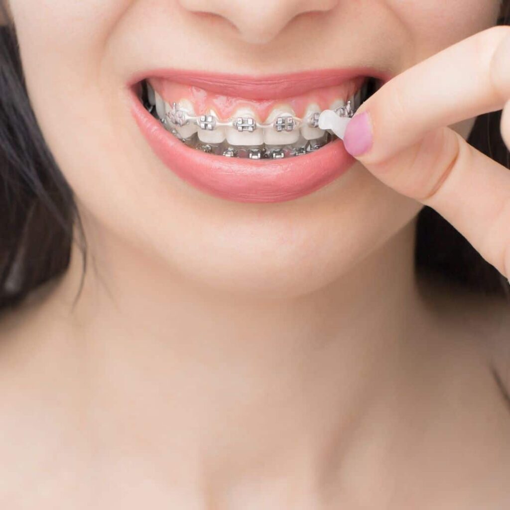 cuidar tu ortodoncia y brackets