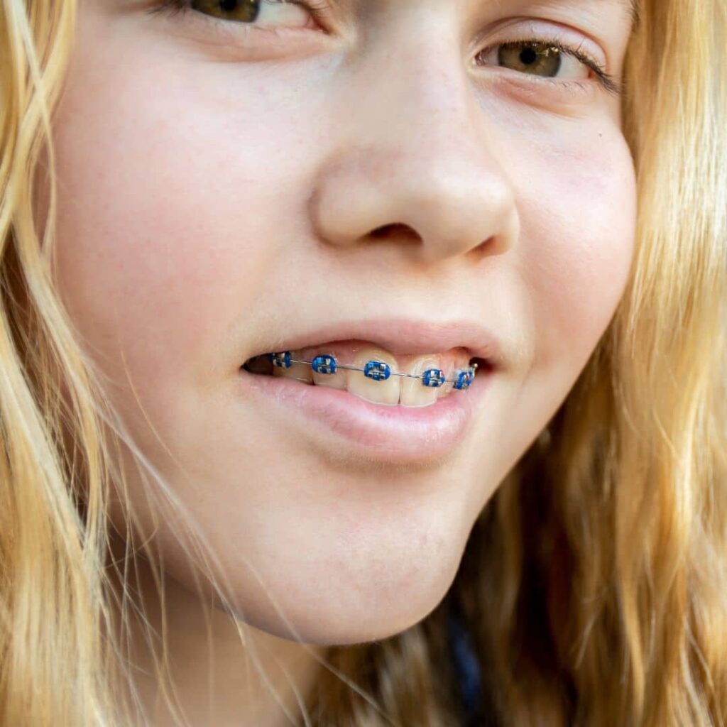 cuidar tu ortodoncia y brackets