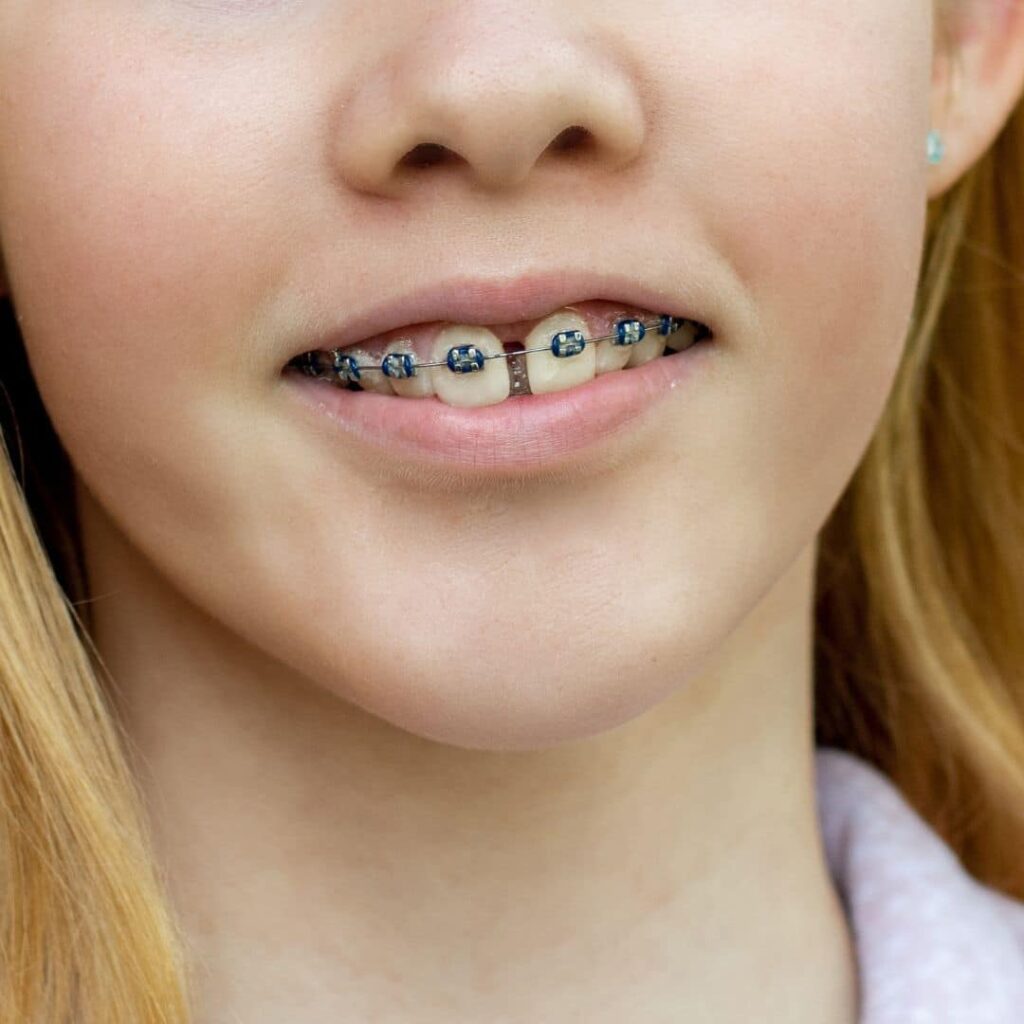 diastema