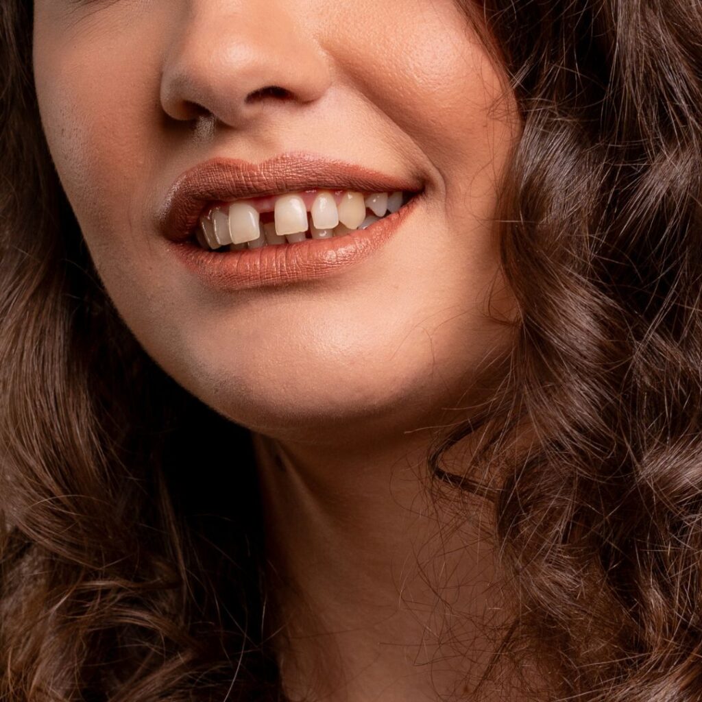 diastema
