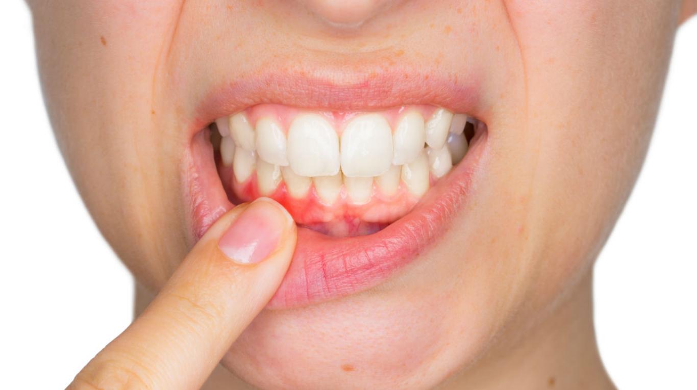 Dentistas en Alcorcón. Gingivitis tratamiento y cuidados. CEM Valderas Odontólogos en Alcorcón