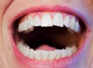 Dentistas Alcorcón: Desmentimos los mitos más arraigados sobre los dientes
