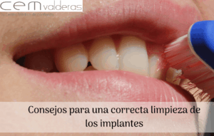 CEM Valderas Dentistas Alcorcón. Consejos para una correcta limpieza de los implantes