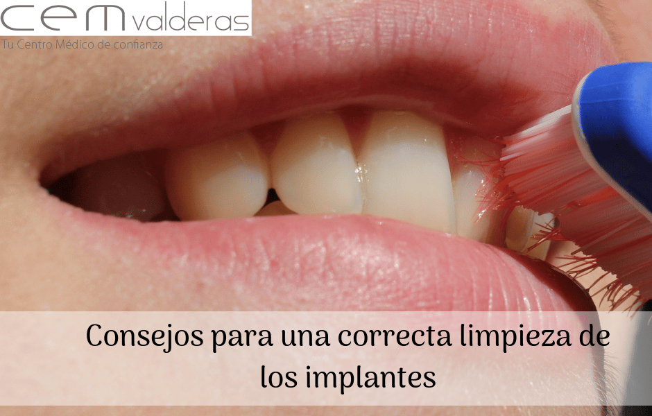 CEM Valderas Dentistas Alcorcón. Consejos para una correcta limpieza de los implantes