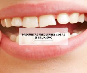 Preguntas frecuentes sobre el bruxismo. Resolvemos todas tus dudas sobre el bruxismo en CEM Valderas odontologos en Alcorcón