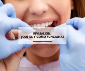 Invisalign, ¿qué es y cómo funciona?. Tratamientos de ortodoncia invisible. Dentistas Alcorcón CEM Valderas