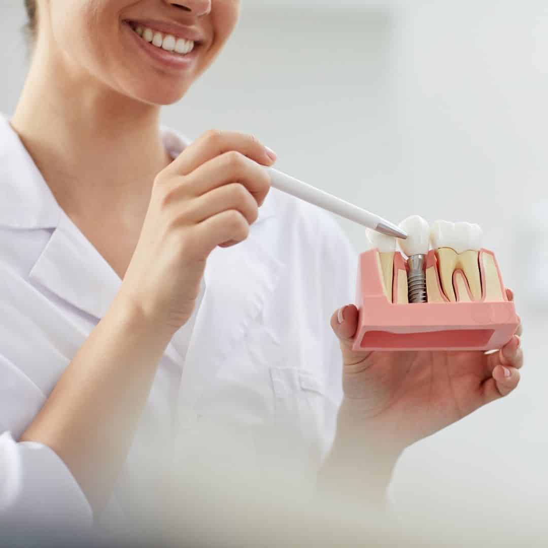 Limpieza de implantes dentales