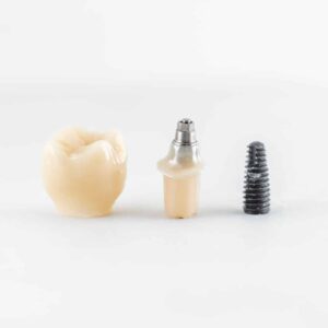 implantes dentales