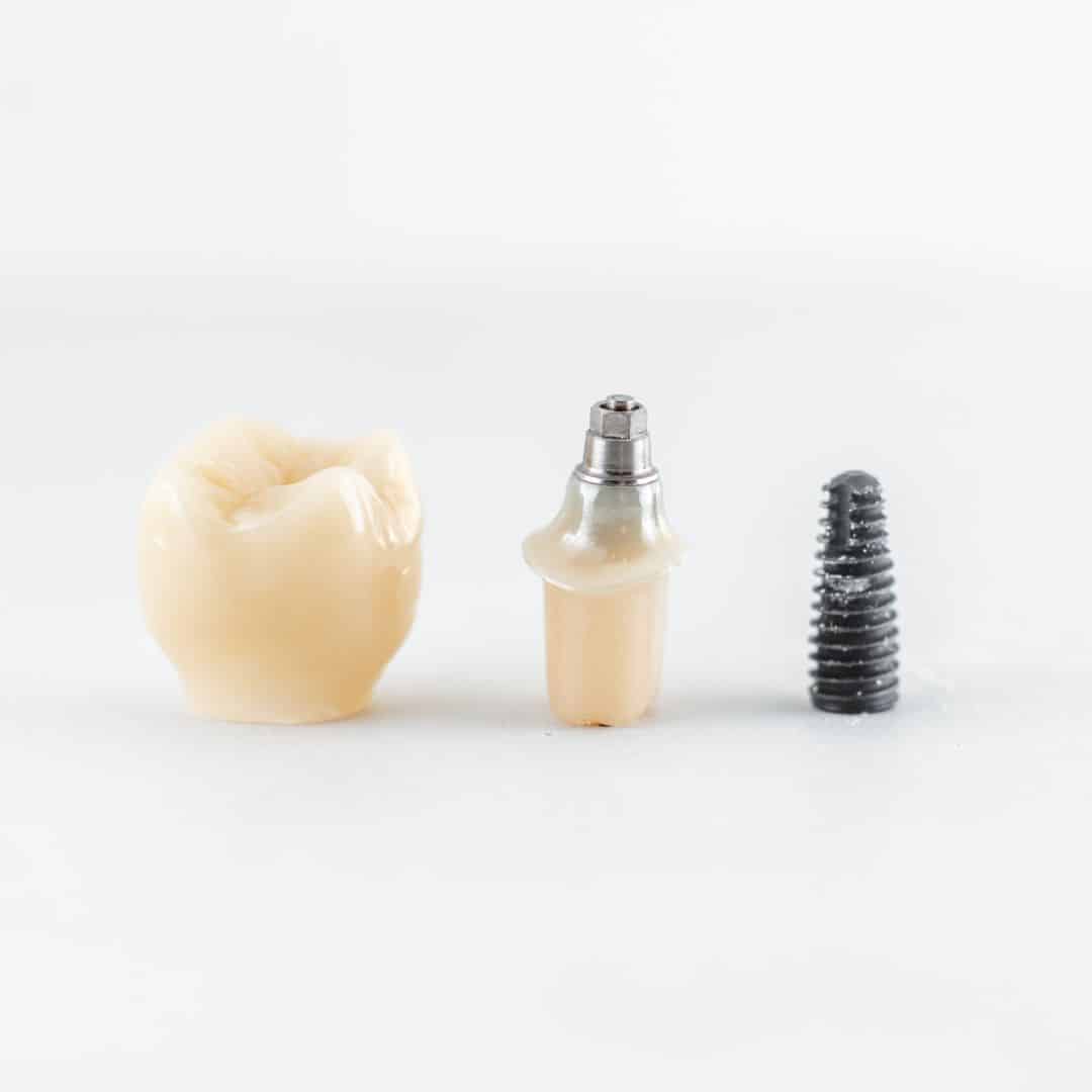 implantes dentales