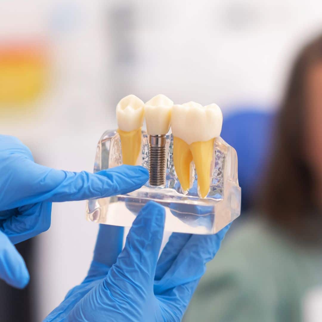Implantes dentales
