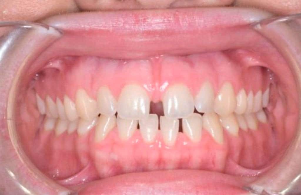 Ortodoncia Invisible: Transformando Sonrisas en Casos Reales ¿Alguna vez has deseado corregir la alineación de tus dientes de manera discreta y efectiva? En la Clínica Dental CEM Valderas, hacemos posible este sueño con nuestra innovadora Ortodoncia Invisible. Descubre cómo hemos transformado sonrisas reales con resultados sorprendentes. Nuestra Experiencia Habla por Sí Misma En nuestra clínica, creemos en la excelencia en la atención dental y en ofrecer soluciones de ortodoncia avanzadas. Nuestra galería de casos reales te muestra el impacto real de la Ortodoncia Invisible en la vida de nuestros pacientes. Desde alineaciones sutiles hasta transformaciones completas, cada caso es un testimonio de éxito. ¿Por Qué Elegir la Ortodoncia Invisible? Invisibilidad: Olvídate de los brackets metálicos. Los alineadores transparentes son prácticamente invisibles. Comodidad: Sin alambres ni brackets que causen molestias. Los alineadores son cómodos y removibles. Resultados Rápidos: En muchos casos, se logran resultados en menos tiempo que con la ortodoncia tradicional. Estilo de Vida Activo: Come, bebe y disfruta de tu vida sin restricciones. Retira los alineadores para comer y cepillarte. Tu Sonrisa, Tu Confianza En la Clínica Dental CEM Valderas, nos enorgullece ofrecer Ortodoncia Invisible como una opción de tratamiento avanzada y efectiva. Nuestros casos reales demuestran que una sonrisa hermosa y alineada es posible sin sacrificios. ¿Listo para transformar tu sonrisa? Contacta con nosotros para una consulta gratuita y descubre cómo la Ortodoncia Invisible puede cambiar tu vida.
