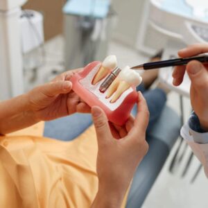 implantes dentales