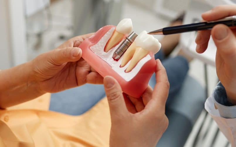 Cómo cuidar los implantes dentales