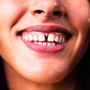 diastema