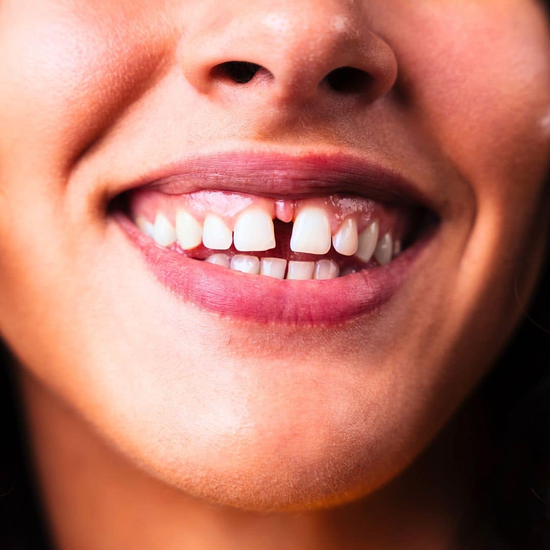 diastema
