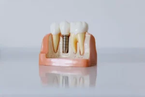 Implante Dental mal colocado, causas, consecuencias, síntomas. CEM Valderas La mejor clínica dental del Sur de Madrid